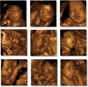 3d-Ultrasound-Pregnancy4